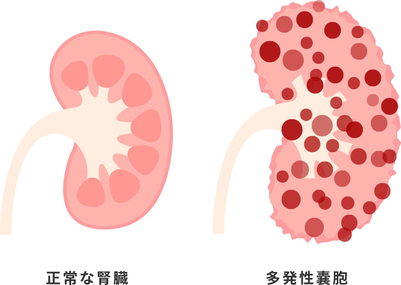 正常な腎臓と多発性嚢胞のイラスト